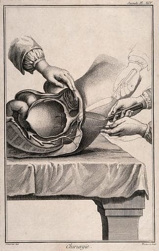 Bladder Trocar