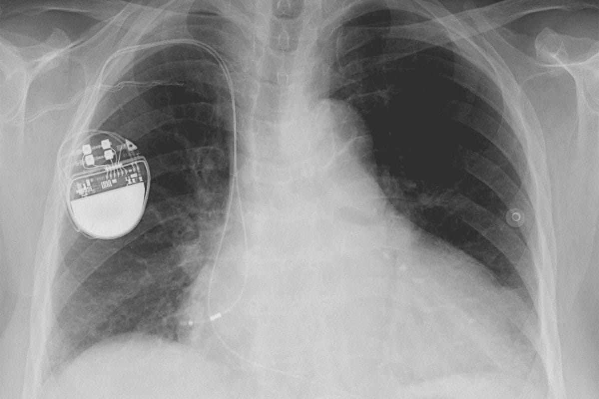 Pacemakers