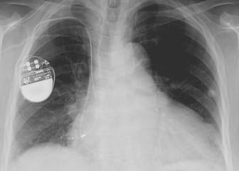 Report: Gadgets Can Interfere With Pacemakers